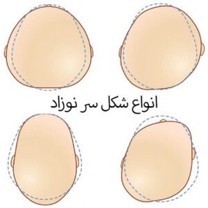 انواع شکل سر نوزاد