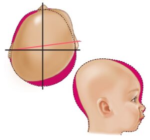 پلاژیوسفالی